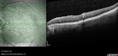 Parafoveal Microaneurysm - Not Diabetic
88 year old man asymptomatic with parafoveal microaneurysm
