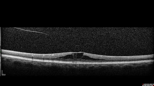 Stellate non-hereditary idiopathic foveomacular retinoschisis (SNIFR) and optic nerve drusen
84 year old man No visual complaints. Not diabetic, cataract surgery 8 years ago.  Meds: Omeprazole, Tamsulosin (Flomax)
VA 20/32 OD, 20/20 OS
