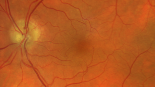 Stellate non-hereditary idiopathic foveomacular retinoschisis (SNIFR) and optic nerve drusen
84 year old man No visual complaints. Not diabetic, cataract surgery 8 years ago.  Meds: Omeprazole, Tamsulosin (Flomax)
VA 20/32 OD, 20/20 OS
