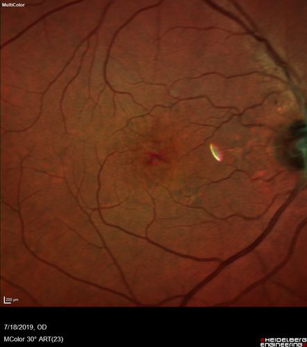 Stellate non-hereditary idiopathic foveomacular retinoschisis (SNIFR) and optic nerve drusen
84 year old man No visual complaints. Not diabetic, cataract surgery 8 years ago.  Meds: Omeprazole, Tamsulosin (Flomax)
VA 20/32 OD, 20/20 OS
