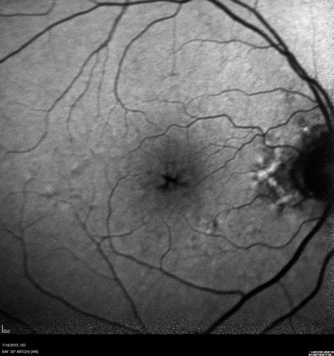 Stellate non-hereditary idiopathic foveomacular retinoschisis (SNIFR) and optic nerve drusen
84 year old man No visual complaints. Not diabetic, cataract surgery 8 years ago.  Meds: Omeprazole, Tamsulosin (Flomax)
VA 20/32 OD, 20/20 OS
