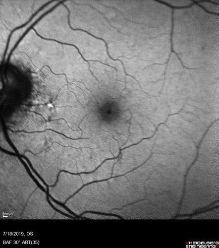 Stellate non-hereditary idiopathic foveomacular retinoschisis (SNIFR) and optic nerve drusen
84 year old man No visual complaints. Not diabetic, cataract surgery 8 years ago.  Meds: Omeprazole, Tamsulosin (Flomax)
VA 20/32 OD, 20/20 OS
