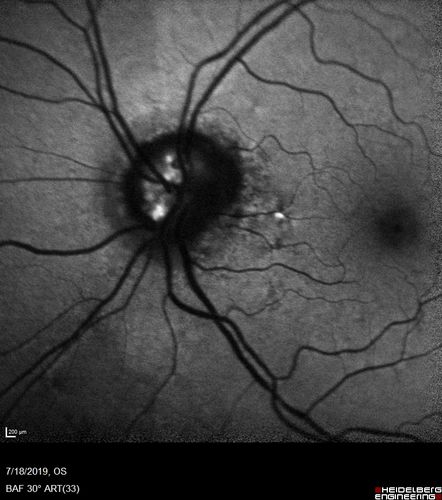 Stellate non-hereditary idiopathic foveomacular retinoschisis (SNIFR) and optic nerve drusen
84 year old man No visual complaints. Not diabetic, cataract surgery 8 years ago.  Meds: Omeprazole, Tamsulosin (Flomax)
VA 20/32 OD, 20/20 OS
