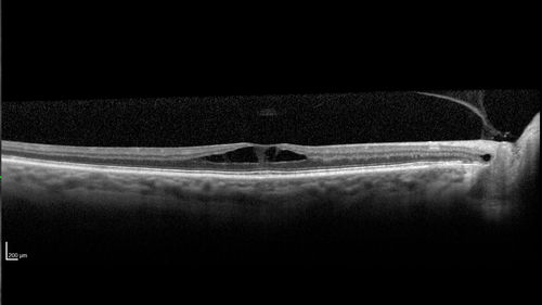 Stellate non-hereditary idiopathic foveomacular retinoschisis (SNIFR) and optic nerve drusen
84 year old man No visual complaints. Not diabetic, cataract surgery 8 years ago.  Meds: Omeprazole, Tamsulosin (Flomax)
VA 20/32 OD, 20/20 OS
