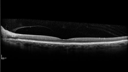 Stellate non-hereditary idiopathic foveomacular retinoschisis (SNIFR) and optic nerve drusen
84 year old man No visual complaints. Not diabetic, cataract surgery 8 years ago.  Meds: Omeprazole, Tamsulosin (Flomax)
VA 20/32 OD, 20/20 OS
