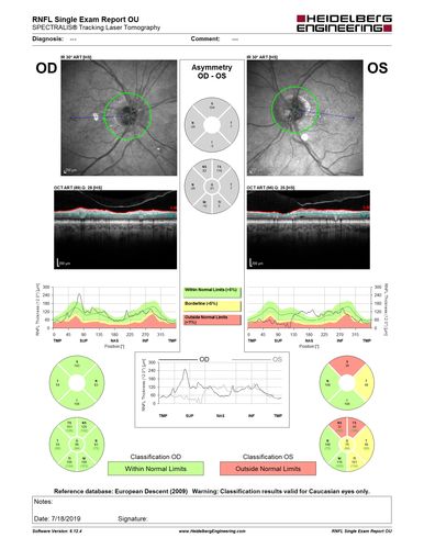 Stellate non-hereditary idiopathic foveomacular retinoschisis (SNIFR) and optic nerve drusen
84 year old man No visual complaints. Not diabetic, cataract surgery 8 years ago.  Meds: Omeprazole, Tamsulosin (Flomax)
VA 20/32 OD, 20/20 OS
