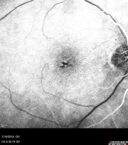 Stellate non-hereditary idiopathic foveomacular retinoschisis (SNIFR) and optic nerve drusen
84 year old man No visual complaints. Not diabetic, cataract surgery 8 years ago.  Meds: Omeprazole, Tamsulosin (Flomax)
VA 20/32 OD, 20/20 OS
