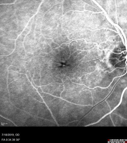 Stellate non-hereditary idiopathic foveomacular retinoschisis (SNIFR) and optic nerve drusen
84 year old man No visual complaints. Not diabetic, cataract surgery 8 years ago.  Meds: Omeprazole, Tamsulosin (Flomax)
VA 20/32 OD, 20/20 OS
