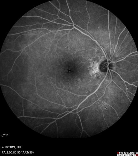 Stellate non-hereditary idiopathic foveomacular retinoschisis (SNIFR) and optic nerve drusen
84 year old man No visual complaints. Not diabetic, cataract surgery 8 years ago.  Meds: Omeprazole, Tamsulosin (Flomax)
VA 20/32 OD, 20/20 OS
