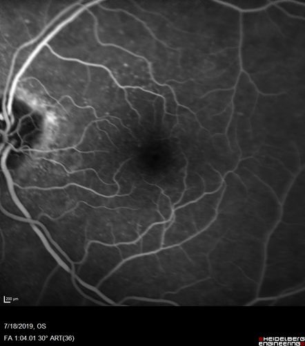 Stellate non-hereditary idiopathic foveomacular retinoschisis (SNIFR) and optic nerve drusen
84 year old man No visual complaints. Not diabetic, cataract surgery 8 years ago.  Meds: Omeprazole, Tamsulosin (Flomax)
VA 20/32 OD, 20/20 OS
