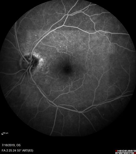 Stellate non-hereditary idiopathic foveomacular retinoschisis (SNIFR) and optic nerve drusen
84 year old man No visual complaints. Not diabetic, cataract surgery 8 years ago.  Meds: Omeprazole, Tamsulosin (Flomax)
VA 20/32 OD, 20/20 OS
