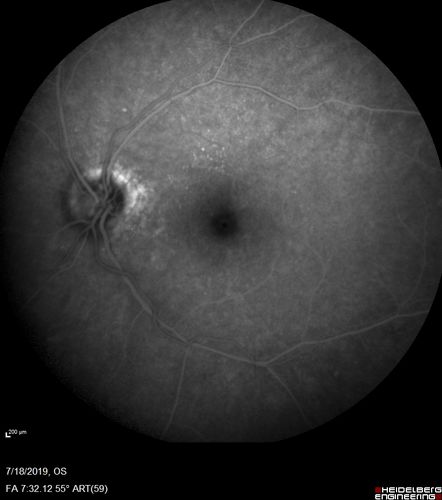 Stellate non-hereditary idiopathic foveomacular retinoschisis (SNIFR) and optic nerve drusen
84 year old man No visual complaints. Not diabetic, cataract surgery 8 years ago.  Meds: Omeprazole, Tamsulosin (Flomax)
VA 20/32 OD, 20/20 OS
