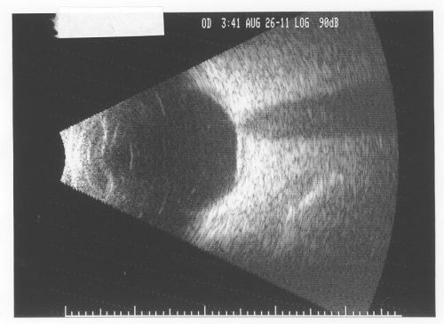Pigmented Choroidal Mass Right Eye - Melanoma vs. Nevus vs. Unilateral Melanocytic Proliferation - Initial Visit B Scan
71-year-old man is vision has been bothering him for about a month.  He does not notice one eye particularly worse than the other.  OD is 20/40, OS is 20/25 - Initial Visit
