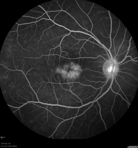 Small vessel vasculitis causing cystoid macular edema - right eye - late frame fluorescein angiography 
36 year old female with no significant past medical history noted painless, progressive loss of vision over one month. BCVA was 20/100 in her right eye. Dilated fundus exam, OCT and FA identified small vessel vasculitis associated with cystoid macular edema. Left eye was also involved with less marked findings. 

