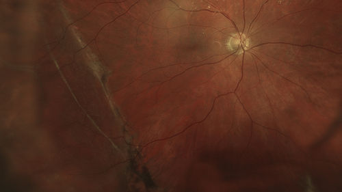 Temporal_RD_laserdemarcation_crjun.jpg