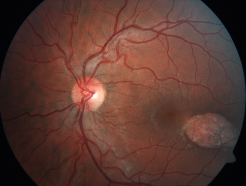 Torpedo Maculopathy - Left Eye
25 year old man with normal vision.  Left macula has torpedo lesion
