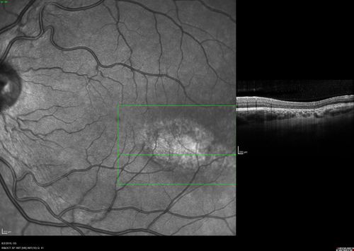 Torpedo Maculopathy - Left Eye
25 year old man with normal vision.  Left macula has torpedo lesion

