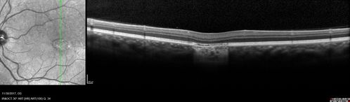 Torpedo Maculopathy
Likely a variant of CHRPE
