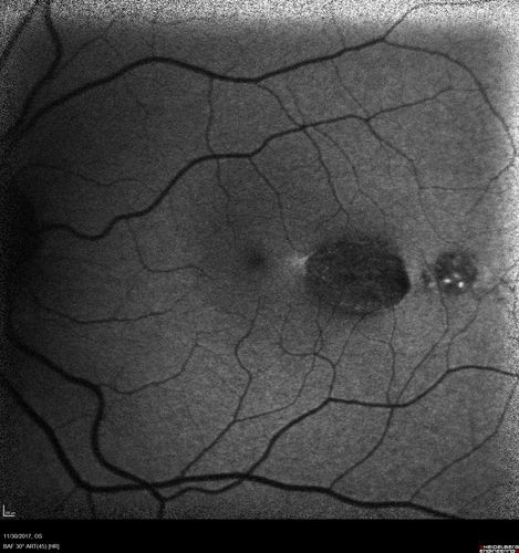 Torpedo Maculopathy
Likely a variant of CHRPE
