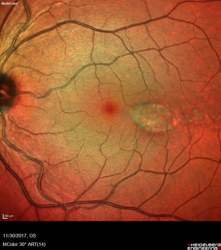 Torpedo Maculopathy
Likely a variant of CHRPE
