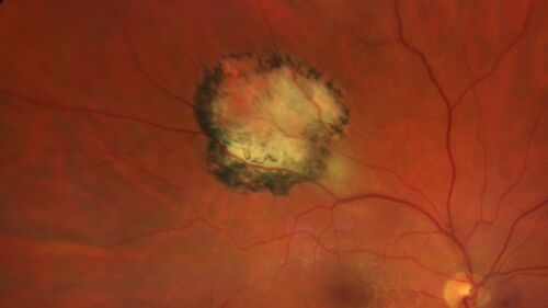 Recurrent Toxoplasmosis - Extramacular
First episode 2016, recurrence in 2020 57 year old man with multiple myeloma
