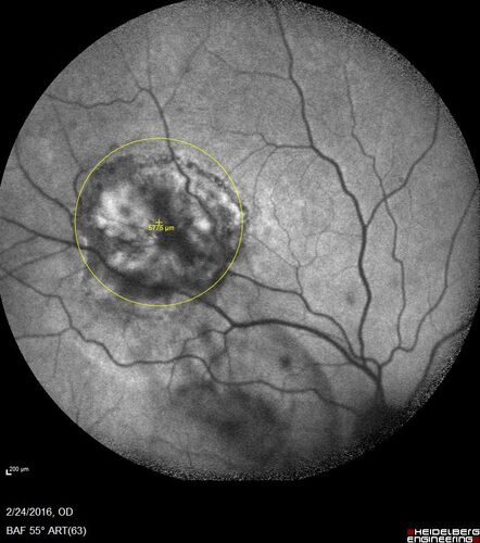 Recurrent Toxoplasmosis - Extramacular
First episode 2016, recurrence in 2020 57 year old man with multiple myeloma
