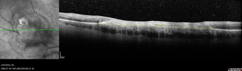 Recurrent Toxoplasmosis - Extramacular
First episode 2016, recurrence in 2020 57 year old man with multiple myeloma
