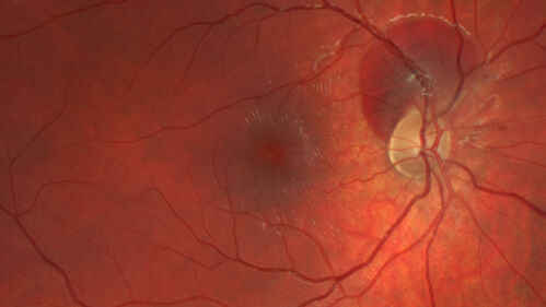 Traumatic Peripapillary Subretinal Hemorrhage
16 year old hit in eye with finger during basketball.  Vision is 20/25 and there is a peripapillary hemorrhage.
