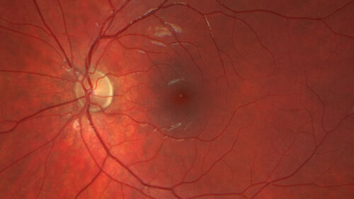 Traumatic Peripapillary Subretinal Hemorrhage
16 year old hit in eye with finger during basketball.  Vision is 20/25 and there is a peripapillary hemorrhage.
