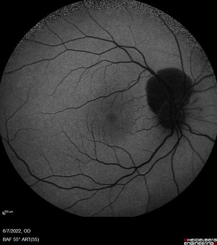 Traumatic Peripapillary Subretinal Hemorrhage
16 year old hit in eye with finger during basketball.  Vision is 20/25 and there is a peripapillary hemorrhage.
