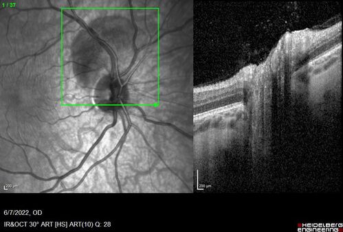 Traumatic Peripapillary Subretinal Hemorrhage
16 year old hit in eye with finger during basketball.  Vision is 20/25 and there is a peripapillary hemorrhage.
