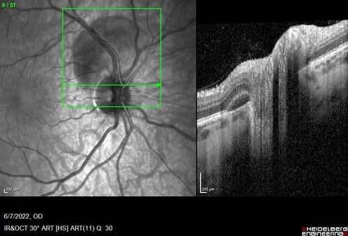 Traumatic Peripapillary Subretinal Hemorrhage
16 year old hit in eye with finger during basketball.  Vision is 20/25 and there is a peripapillary hemorrhage.
