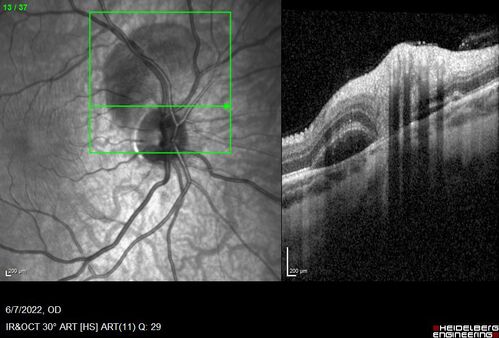 Traumatic Peripapillary Subretinal Hemorrhage
16 year old hit in eye with finger during basketball.  Vision is 20/25 and there is a peripapillary hemorrhage.
