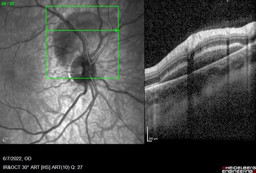 Traumatic Peripapillary Subretinal Hemorrhage
16 year old hit in eye with finger during basketball.  Vision is 20/25 and there is a peripapillary hemorrhage.

