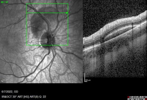 Traumatic Peripapillary Subretinal Hemorrhage
16 year old hit in eye with finger during basketball.  Vision is 20/25 and there is a peripapillary hemorrhage.
