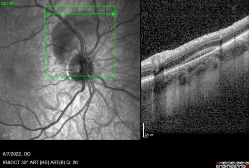 Traumatic Peripapillary Subretinal Hemorrhage
16 year old hit in eye with finger during basketball.  Vision is 20/25 and there is a peripapillary hemorrhage.
