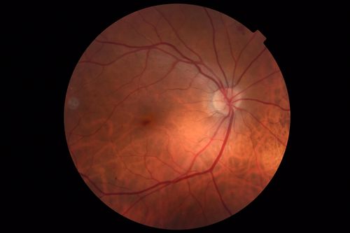 Vitreous Hemorrhage with no evidence of PDR in the left eye
74 year old man with vision loss OS for about a week.  The FA shows no PDR in the left eye but the right eye has very mild NVD. Diabetes for 40 years now on insulin.
