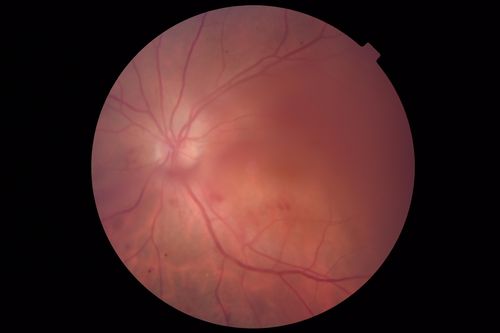 Vitreous Hemorrhage with no evidence of PDR in the left eye
74 year old man with vision loss OS for about a week.  The FA shows no PDR in the left eye but the right eye has very mild NVD. Diabetes for 40 years now on insulin.
