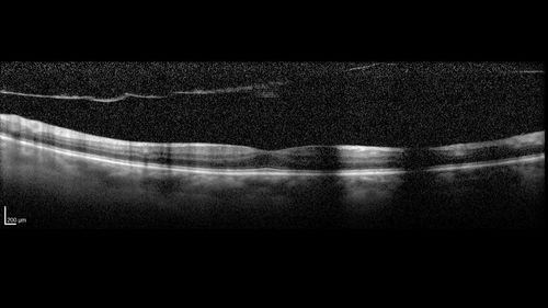 Vitreous Hemorrhage with no evidence of PDR in the left eye
74 year old man with vision loss OS for about a week.  The FA shows no PDR in the left eye but the right eye has very mild NVD. Diabetes for 40 years now on insulin.
