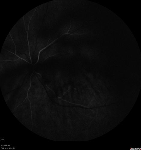 Vitreous Hemorrhage with no evidence of PDR in the left eye
74 year old man with vision loss OS for about a week.  The FA shows no PDR in the left eye but the right eye has very mild NVD. Diabetes for 40 years now on insulin.
