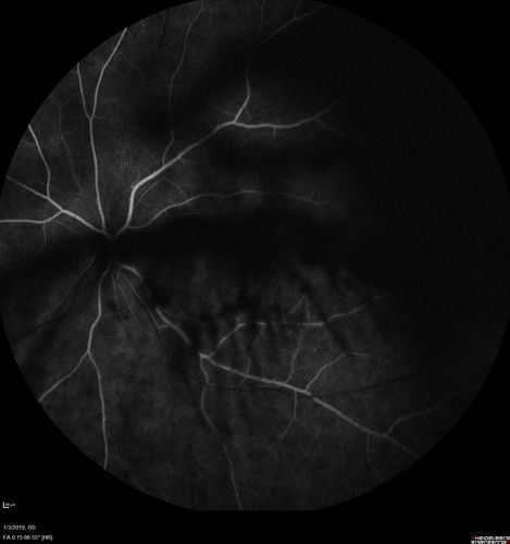 Vitreous Hemorrhage with no evidence of PDR in the left eye
74 year old man with vision loss OS for about a week.  The FA shows no PDR in the left eye but the right eye has very mild NVD. Diabetes for 40 years now on insulin.

