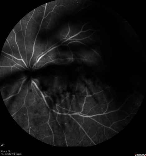 Vitreous Hemorrhage with no evidence of PDR in the left eye
74 year old man with vision loss OS for about a week.  The FA shows no PDR in the left eye but the right eye has very mild NVD. Diabetes for 40 years now on insulin.
