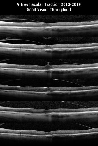 Vitreomacular traction - spontaneous release
80 year old man with transient vision loss from 20/20 - 20/30 from vitreomacular traction.  No surgery or procedure was done.
