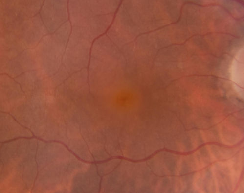 Macular Hole - Asymptomatic
71 year old female did not notice 20/200 macular hole. Post surgery vision improved to 20/30
