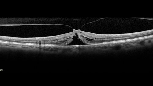 Macular Hole - Asymptomatic
71 year old female did not notice 20/200 macular hole. Post surgery vision improved to 20/30
