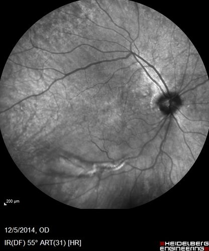 Vitreomacular traction - 20/40 vision and symptomatic with metamorphopsia
