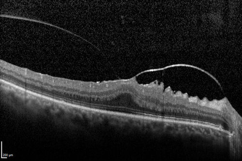 Vitreomacular traction - 20/40 vision and symptomatic with metamorphopsia
