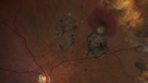 Vasoproliferative Tumor 7 Years after Retinal Detachment Repair
65 year old female presents 7 years following retinal detachment repair with peripheral white mass with hemorrhage.
