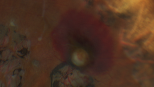 Vasoproliferative Tumor 7 Years after Retinal Detachment Repair
65 year old female presents 7 years following retinal detachment repair with peripheral white mass with hemorrhage.
