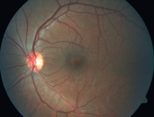 White Retinal Artiole Left eye - Inferotemporal
31 year old female with migraines and headaches for the last 12-13 years.  Sometimes she gets the visual symptoms with the migraine.  When she gets the migraines the pain is on the left side of her head.  She gets the problem a few times a month, sometimes more.  They usually last 5-6  hours. She has not had a permanent vision change.  When she gets a vision change there are spotty dots of blue neon lights in her vision.  With her glasses her two eyes are about the same.  VA 20/16 in Each Eye
